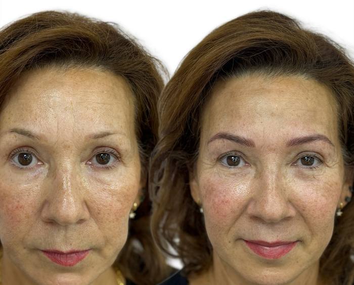 Antes y después de micropigmentación de cejas en Gemma Beauty Palace